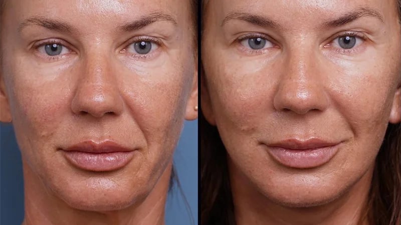 before and after of facelift and necklift female patient Palm Beach, FL