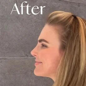 after plastic surgery left view female patient Palm Beach, Florida
