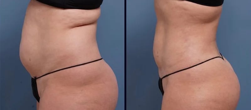 right side before and after liposuction female patient Palm Beach, FL