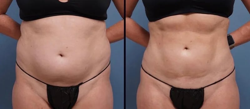 front before and after liposuction female patient Palm Beach, FL