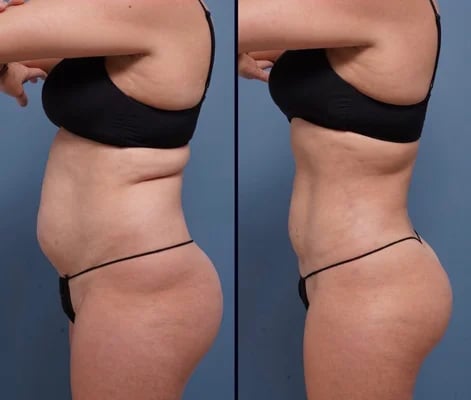 before and after liposuction left side view female patient Palm Beach, FL