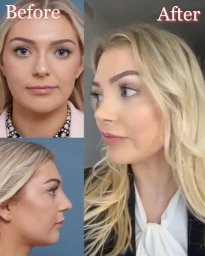 before and after rhinoplasty female patient Palm Beach, FL