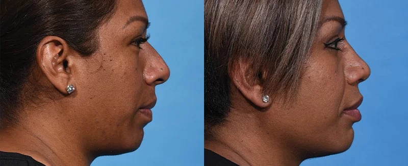 before and after rhinoplasty right view female patient Palm Beach, FL