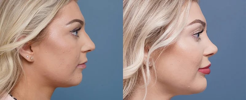 before and after rhinoplasty right view female patient Palm Beach, FL