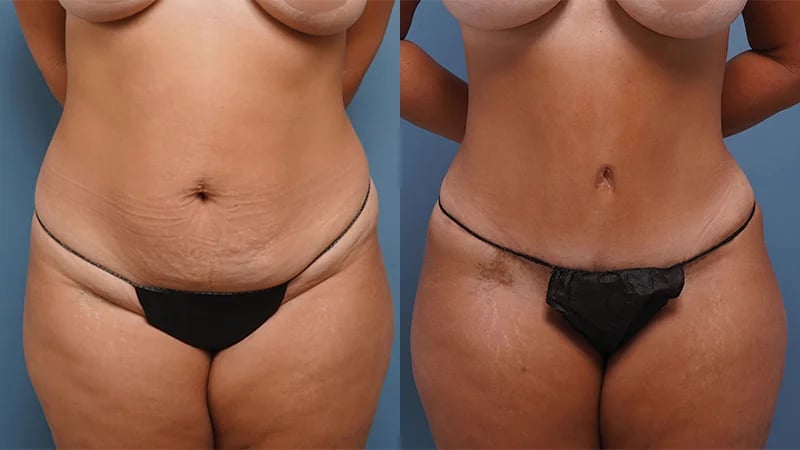 before and after front view female patient tummy tuck Palm Beach. FL