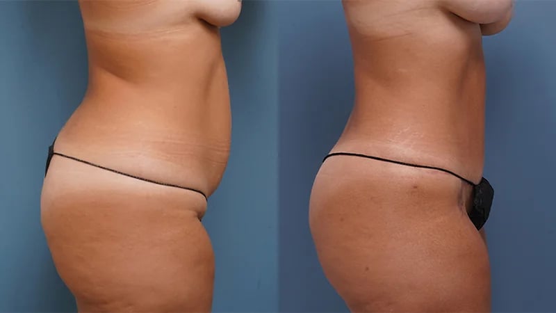 right side view before and after female patient tummy tuck Palm Beach, FL