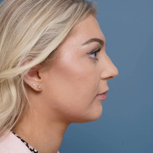 before rhinoplasty right side view female patient case 798