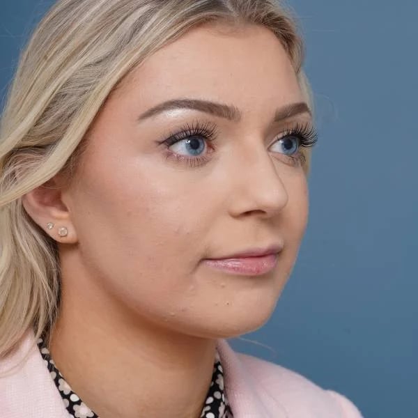 before rhinoplasty right angle view female patient case 798