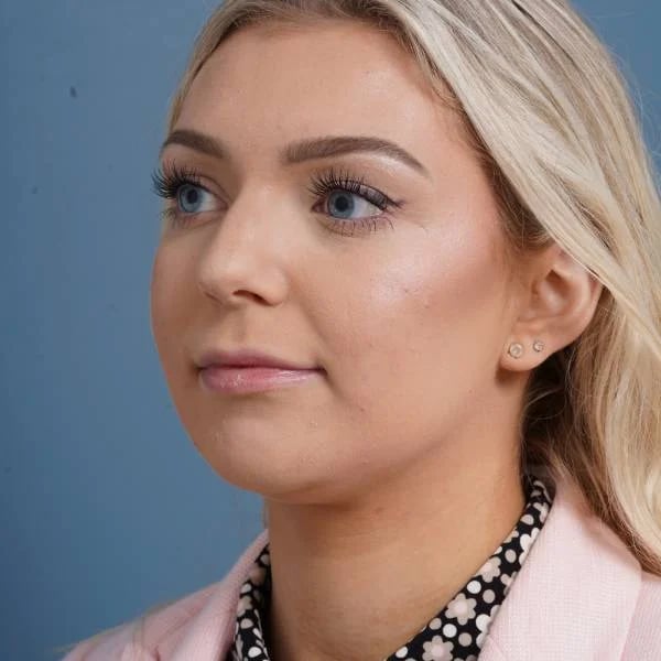 before rhinoplasty left angle view female patient case 798
