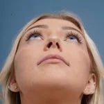 before rhinoplasty front head up view female patient case 798