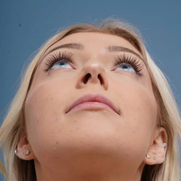before rhinoplasty front head up view female patient case 798