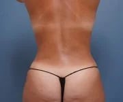 After back view female patient Tummy Tuck Case 784 Palm Beach, FL