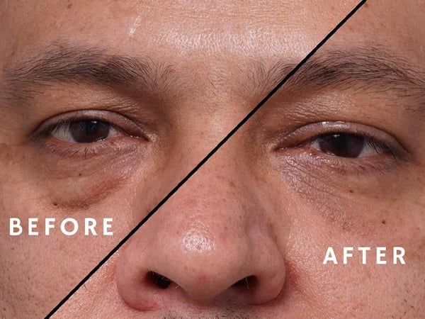 before and after of male patient blepharoplasty brow lift Palm Beach, FL
