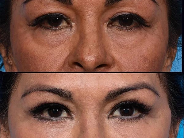before and after photo of female patient blepharoplasty brow lift Palm Beach, FL