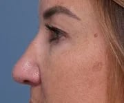 before brow lift left side closeup view female patient case 1560