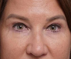 after brow lift front closeup view female patient case 1560