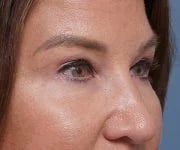 after brow lift right angle closeup view female patient case 1560