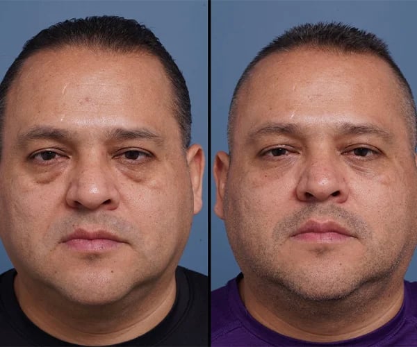 before and after blepharoplasty brow lift front view male patient case 1571