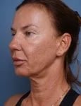before facelift neck lift left angle view female patient case 1582