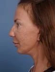 after facelift neck lift left side view female patient case 1582