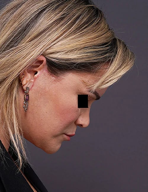 after facelift neck lift right side face down view female patient case 1573