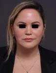 after facelift neck lift front view female patient case 1573
