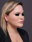 after facelift neck lift right angle view female patient case 1573