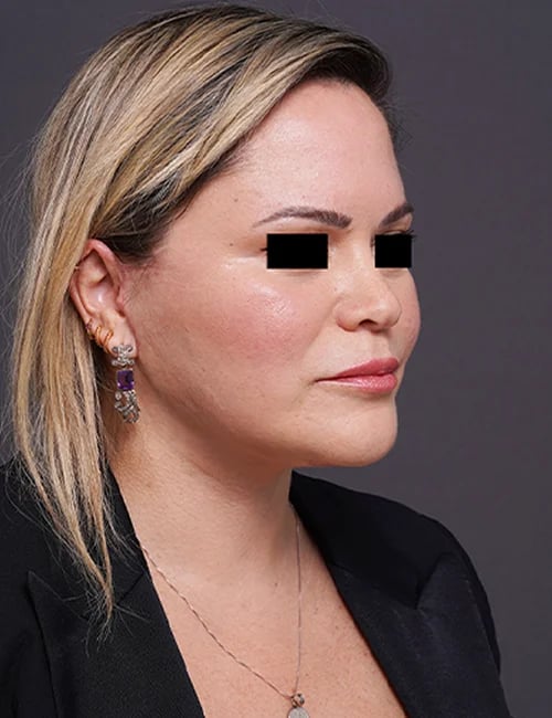 after facelift neck lift right angle view female patient case 1573