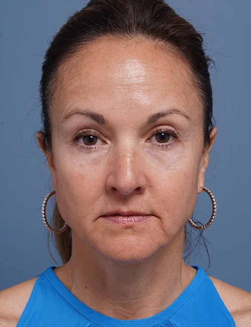 before facelift neck lift front view female patient case 1602