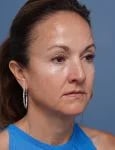 before facelift neck lift right angle view female patient case 1602