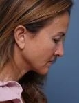 after facelift neck lift right side head down view female patient case 1602