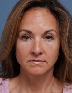 after facelift neck lift front view female patient case 1602