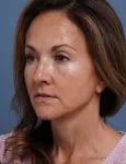 after facelift neck lift left angle view female patient case 1602