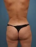 back view of female patient before mommy makeover procedure case 1624 Palm Beach, FL