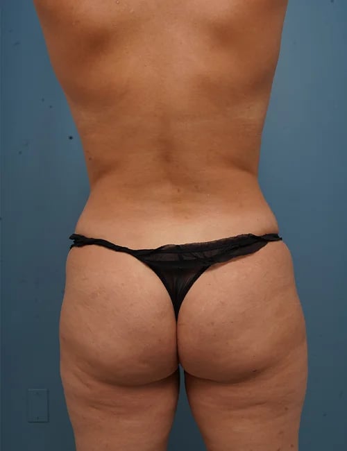 back view of female patient before mommy makeover procedure case 1624 Palm Beach, FL
