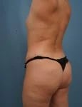 left side angled rear view of female patient before mommy makeover procedure case 1624 Palm Beach, FL