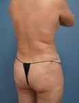 right side diagonal view of female patient after mommy makeover case 1624 Palm Beach, FL