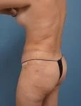 left side diagonal rear view of female patient after mommy makeover case 1624 Palm Beach, FL