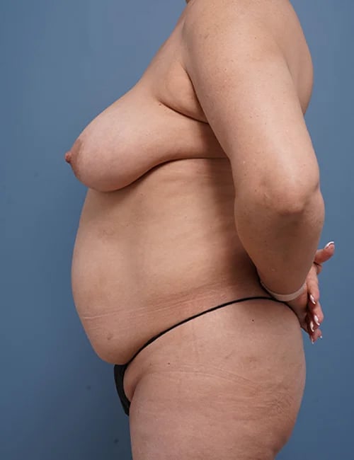 left side view of female patient before mommy makeover case 1641 Palm Beach, FL