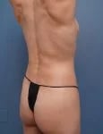 backside diagonal view of female patient before mommy makeover case 1648 Palm Beach, FL