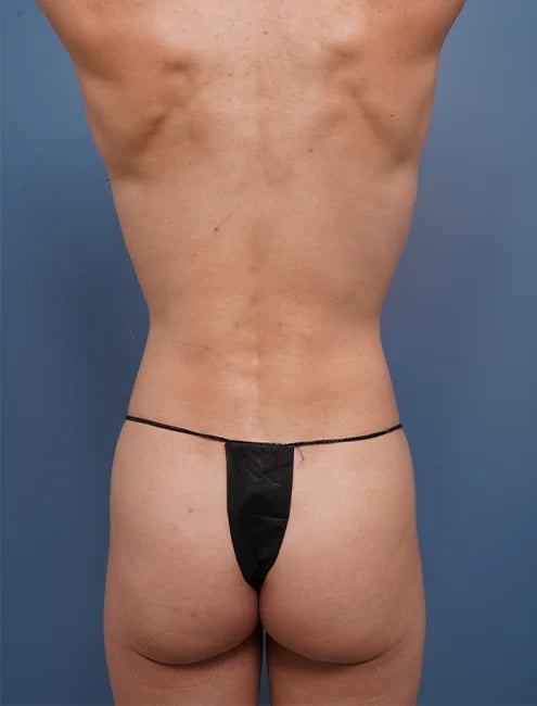 back view of female patient before mommy makeover case 1648 Palm Beach, FL