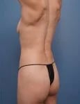 left backside diagonal view of female patient before mommy makeover case 1648 Palm Beach, FL