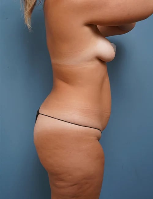 right side view of female patient before mommy makeover case 1665 Palm Beach, FL