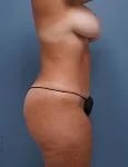 right side view of female patient before mommy makeover case 1665 Palm Beach, FL