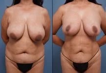 before and after front view of female patient mommy makeover case 1672 Palm Beach, FL