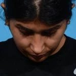 after rhinoplasty front head down view female patient case 1199