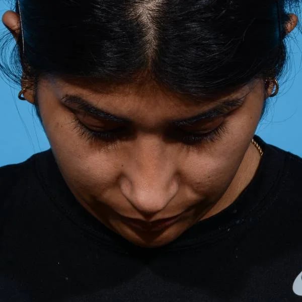 after rhinoplasty front head down view female patient case 1199