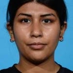 after rhinoplasty front view female patient case 1199