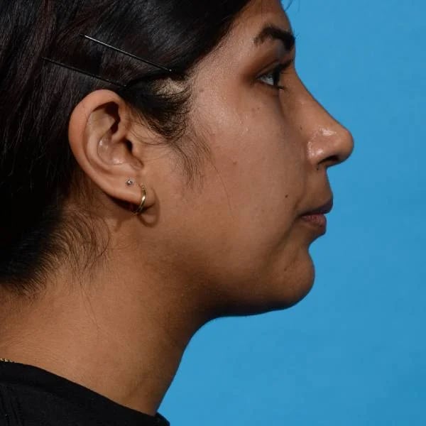 after rhinoplasty right side view female patient case 1199