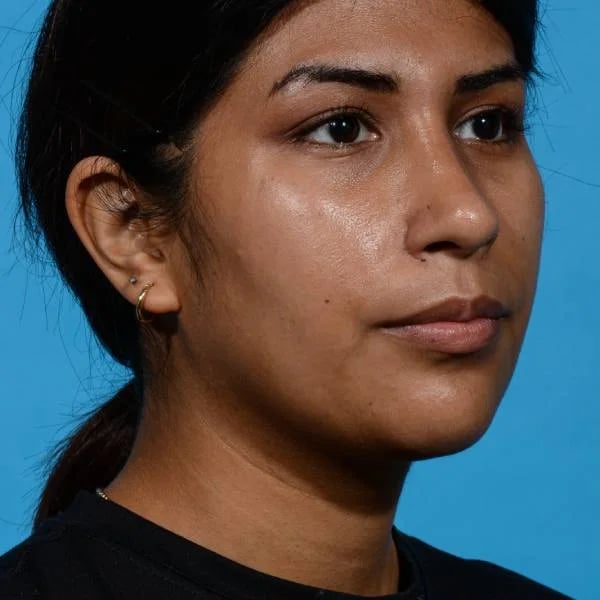 after rhinoplasty right angle view female patient case 1199